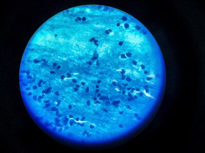 A sample that tested positive for tuberculosis.