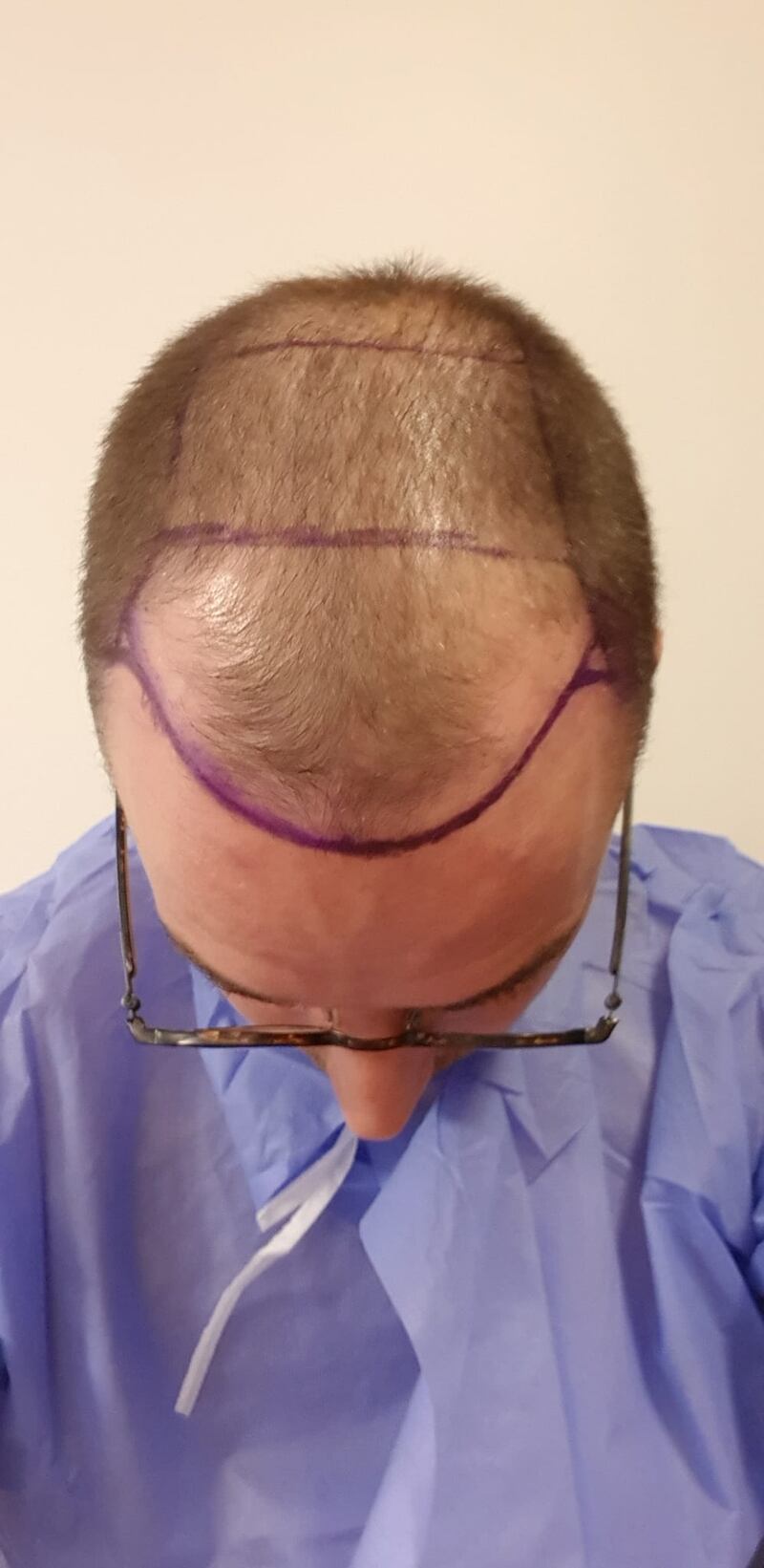 Juan José Manzano before his hair transplant