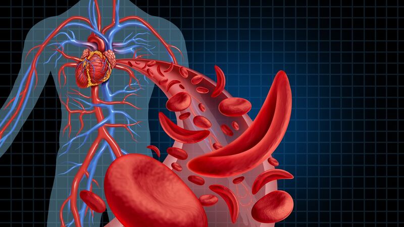 Sickle Cell Disease is so-named because abnormal haemoglobin causes red blood cells to become rigid, sticky and shaped like sickles