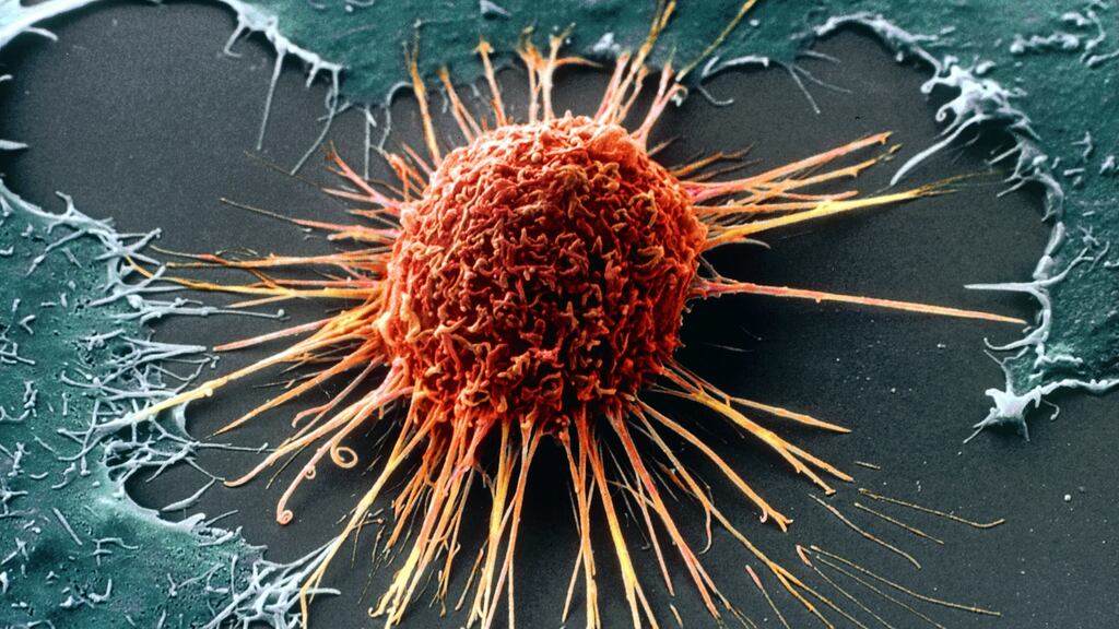 A coloured scanning electron micrograph of a cervical cancer cell.