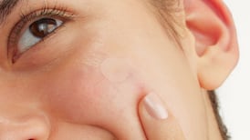 Skincare: Do pimple patches work, or are they just a quick fix?
