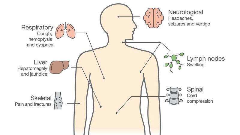 Most common sites and symptoms of cancer metastasis. Illustration: iStock