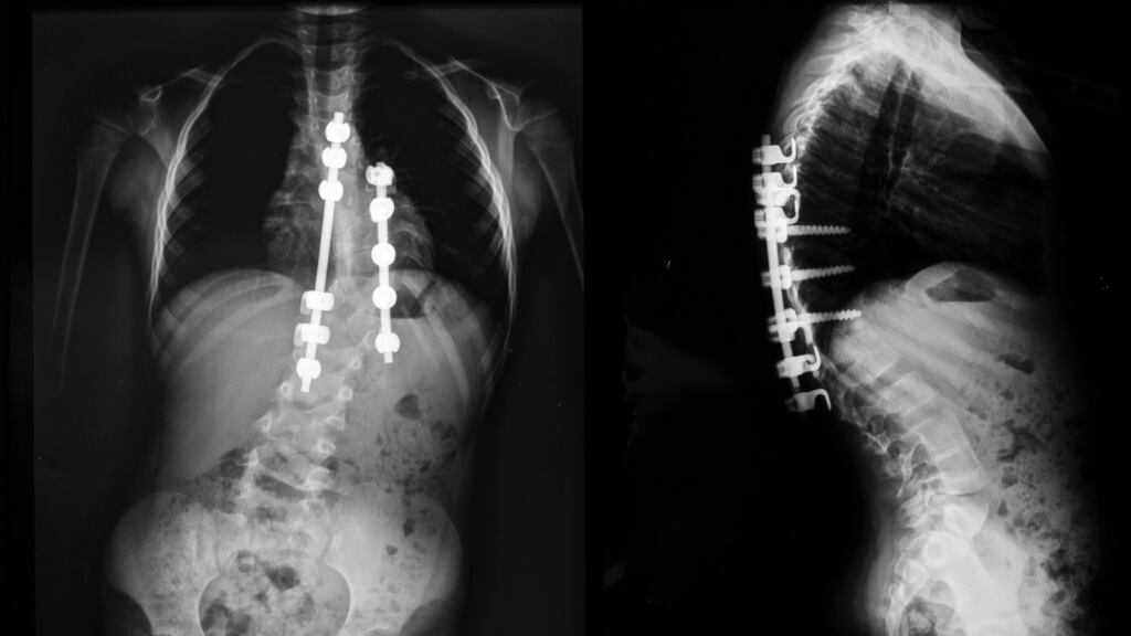 What Temple Street hospital described a 'temporary pause' on complex spinal surgery for three weeks was a 'huge concern' for children awaiting scoliosis surgery, the Scoliosis Advocacy Network said. Image: iStock.