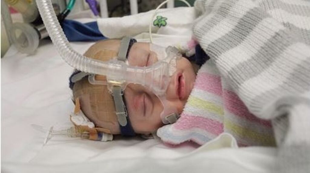 A file picture of a premature baby in need of respiratory support. A baby girl with brain damage at the centre of  a current British case cannot be identified. File photograph: Getty Images