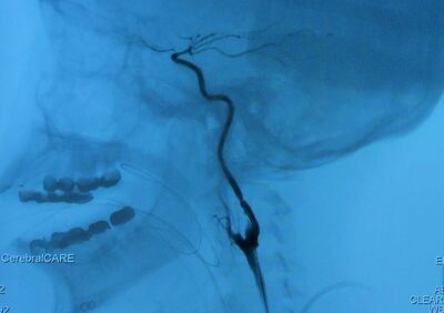 An angiogram showing a blockage in Ms Roy’s internal carotid artery.