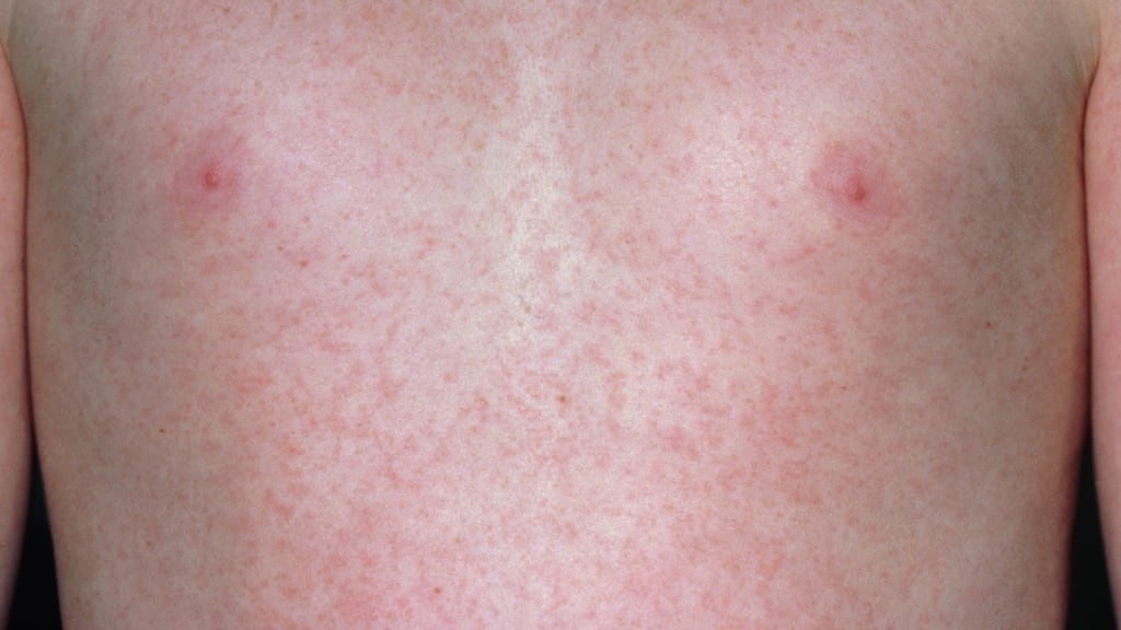 More than 41,000 people in Europe have been infected with measles in the first half of this year. according to the World Health Organisation. Some 76 cases have been recorded in Ireland.