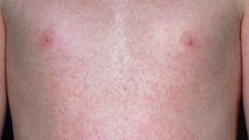 Measles outbreak in Ireland reaches 76 as Europe sees surge in cases