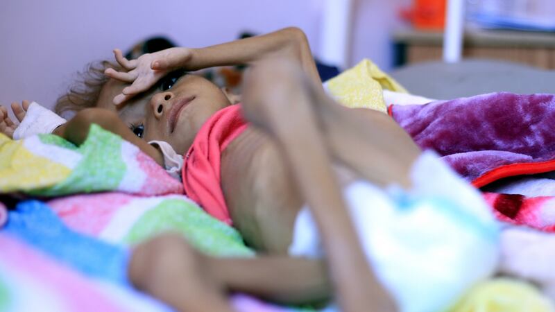 A malnourished child receives treatment in Sanaa, Yemen in early October. Photograph: Yahya Arhab/EPA