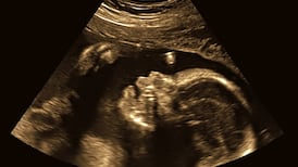 William Reville: Eugenics is wrong about Down syndrome