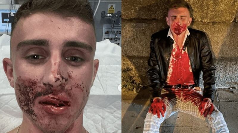 Irish Olympian Jack Woolley after his attack in Dublin city centre: the 22-year-old was out socialising when a man, one of group, randomly punched him full force in the face.