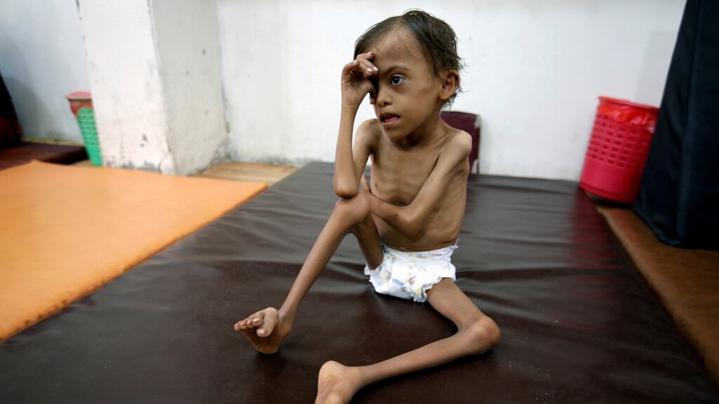 A malnourished child, Marwan Ahmad Mahyoub (10), sits at a special care centre where he receives rehabilitation exercises in the Red Sea port city of Hodeidah, Yemen, on August 19th. Photograph: Abduljabbar Zeyad/Reuters
