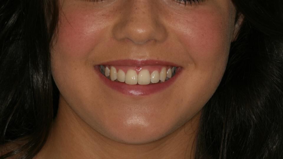 Stacey McNulty after her treatment. Stacey is one of the success stories of public health orthodontic services.