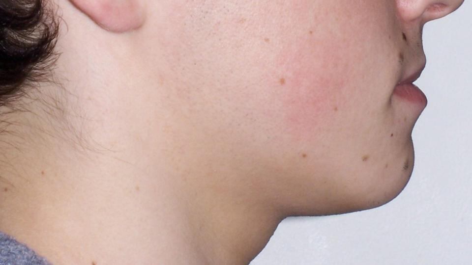 Jason Sheridan after his treatment.