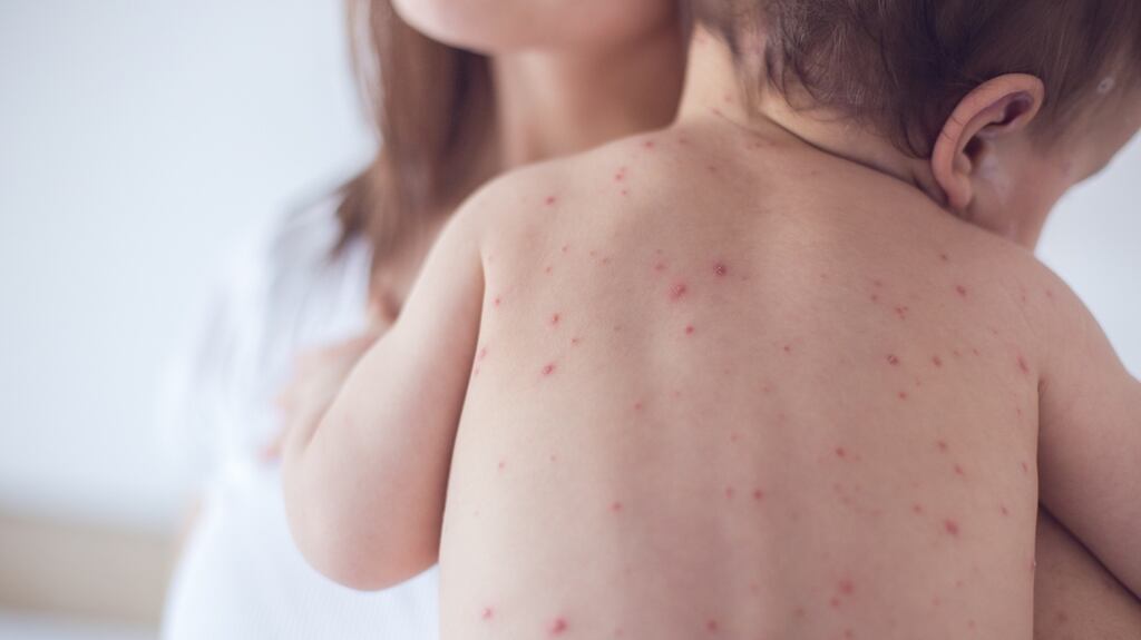 Symptoms to look out for are irritation, flu-like symptoms, a rash in the case of measles and swelling along the jaw line with mumps. File photograph: Getty