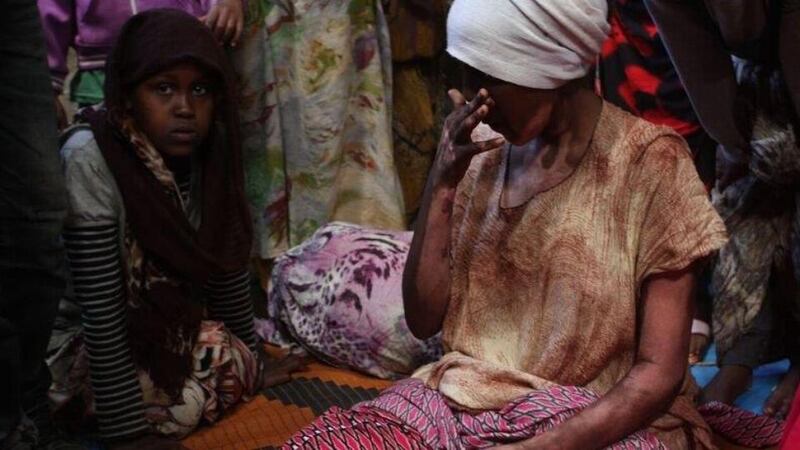 At a camp for displaced Oromo outside Harar, Husaida Mohammed has burns visible on her arms and neck as a result of evictions from the Somali region. Photograph: James Jeffrey