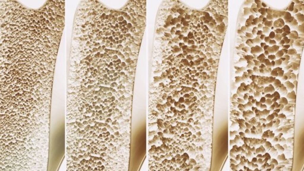 Vitamin D supplements have long been recommended for older people to treat or prevent osteoporosis.