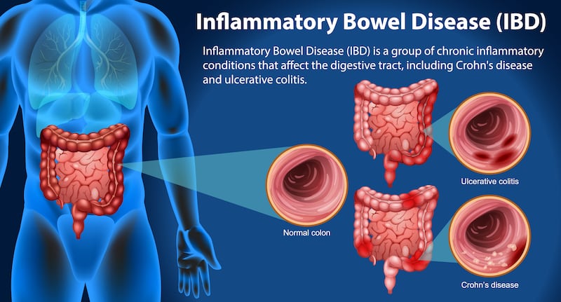 The two main types of inflammatory bowel disease are Crohn’s disease, which occurs in patches in any part of the gastrointestinal tract, and ulcerative colitis, which affects the large intestine