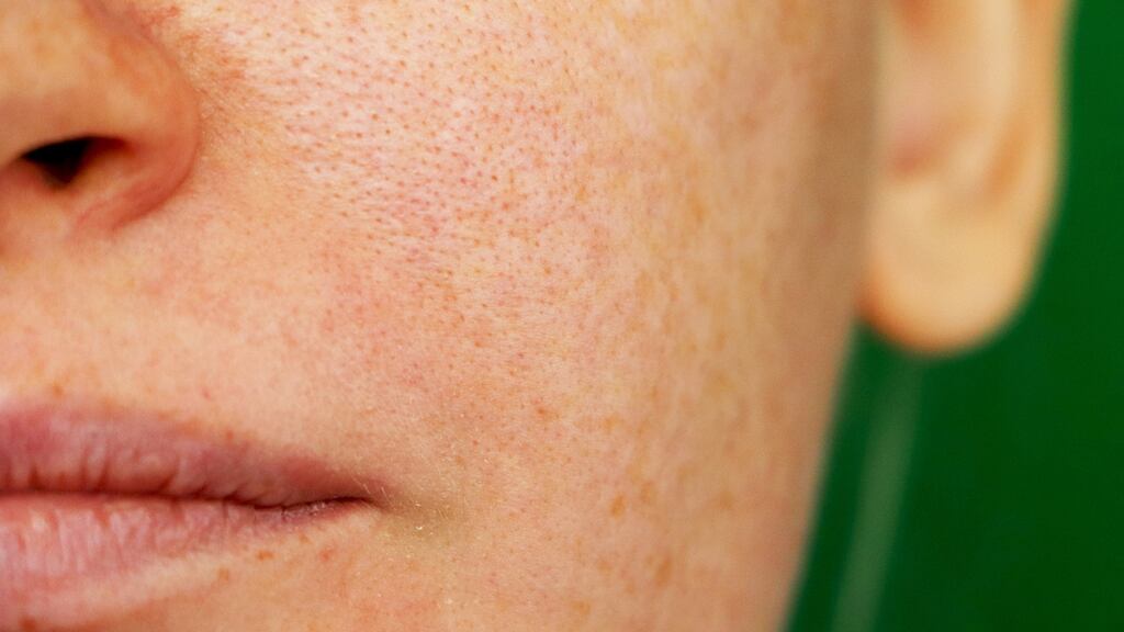 “The main cause of pigmentation is sun exposure.” Photograph: iStock