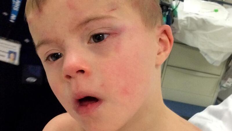 Riley Gedge-Duffy (5) suffered burns to his arms, back and head when a tumble dryer automatically started with the boy, who has Down Syndrome, stuck inside. Photograph: Handout/Aaron Duffy/PA Wire