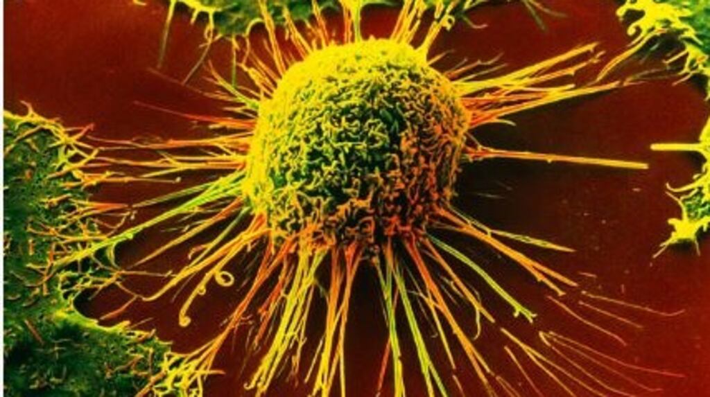 Coloured scanning electron micrograph  of a cell of a cervical carcinoma. File photograph: Getty Images