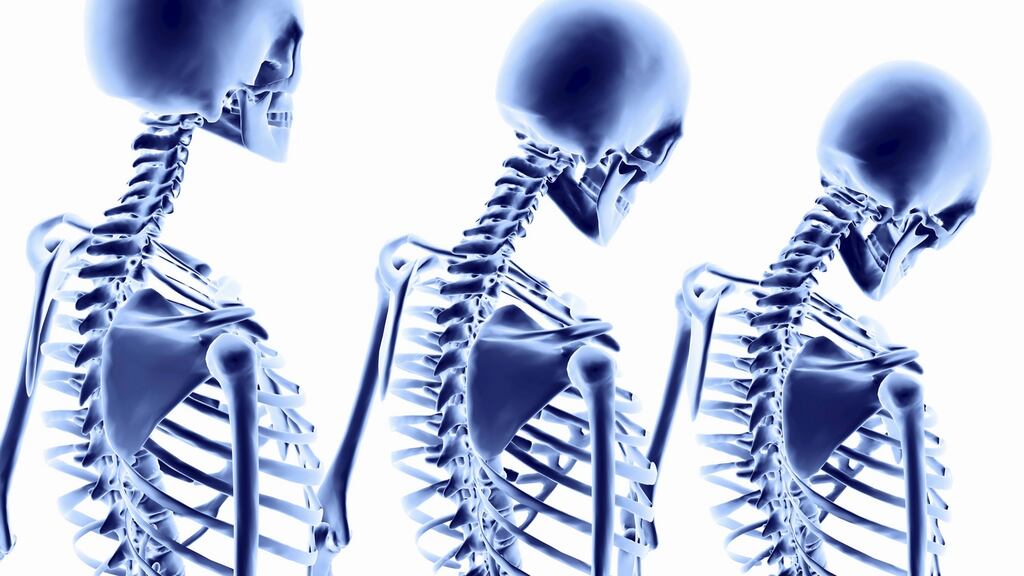 It is estimated that 300,000 people in Ireland have osteoporosis, which causes the inside of bones to become easily breakable. One in four men and one in two women over 50 will break a bone due to the condition.
