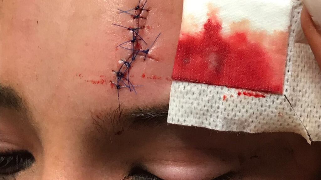 Katie O’Donoghue’s injury after she was struck with a glass bottle at Longitude. Photograph: Katie O’Donoghue