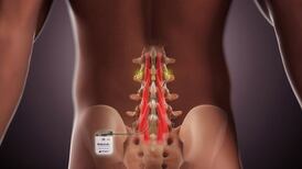 Mainstay meets with FDA on ReActiv8 application