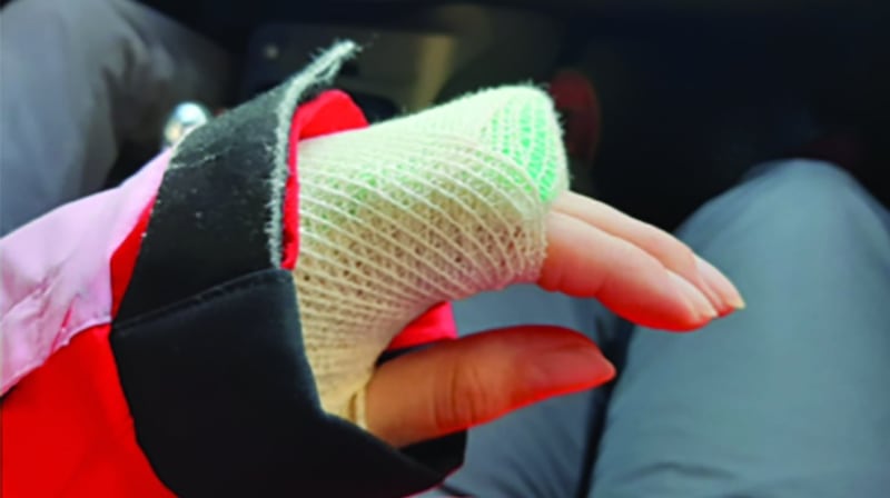 Ruby Moore broke her wrist while snowboarding