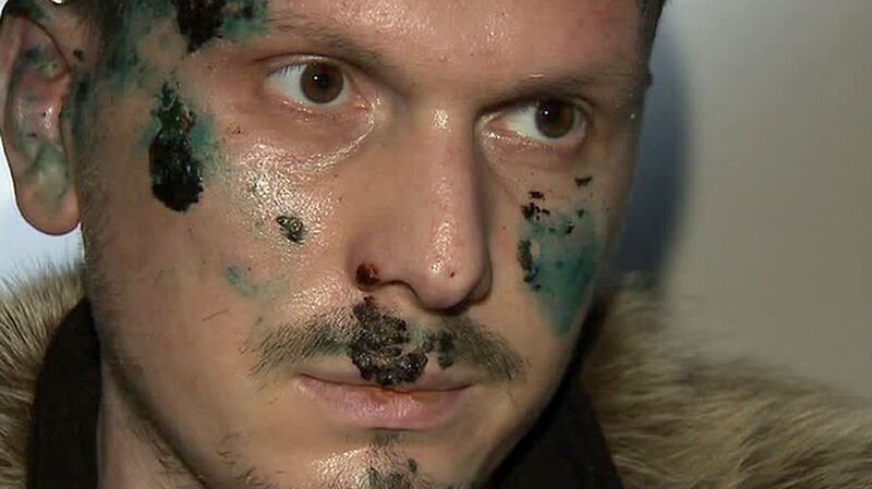 Adam Osmayev, who was injured in Monday night’s attack. Photograph: AFP/Getty Images