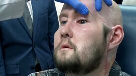 World’s first eye transplant performed on man who suffered electric shock