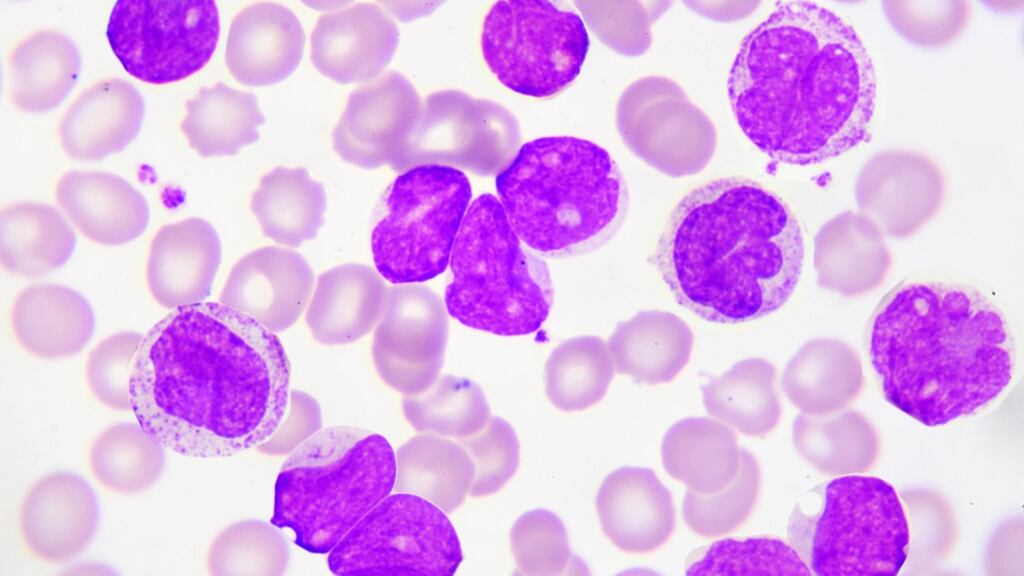A file image of leukemia cells. An over-sterile germ-free environment in the first year of life is one of the major causal factors behind childhood leukaemia, a new study suggests. Image: iStock.
