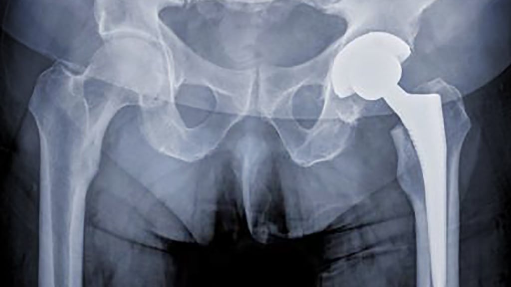 In Ireland, about 3,300 patients received these implants, across 16 public and 14 private hospital sites nationwide.