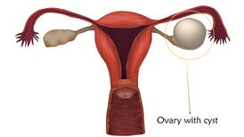 Woman, told she was pregnant, had ovarian cyst weighing eight times an average newborn