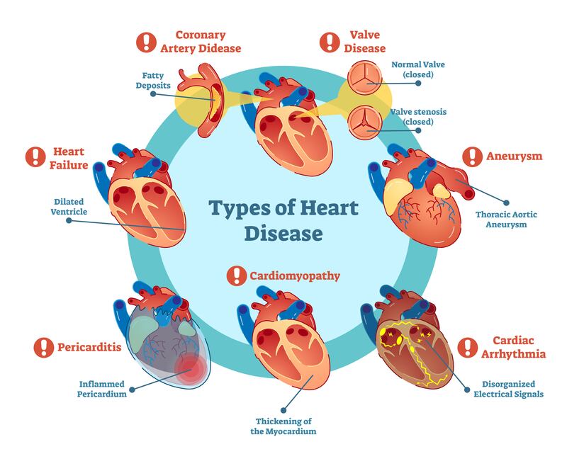 Types of heart disease. Illustration: iStock