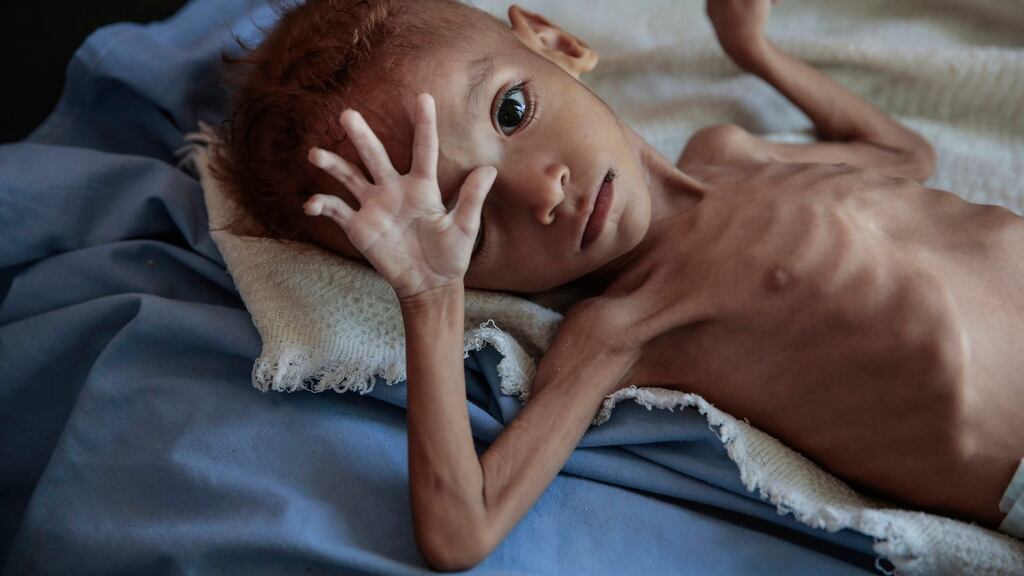 A severely malnourished boy rests on a hospital bed at the Aslam Health Center, Hajjah, Yemen in October. Photograph: Hani Mohammed/AP