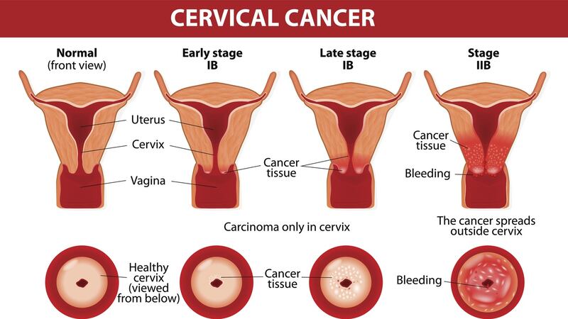 Cervical cancer is the most commonly associated cancer with the HPV virus