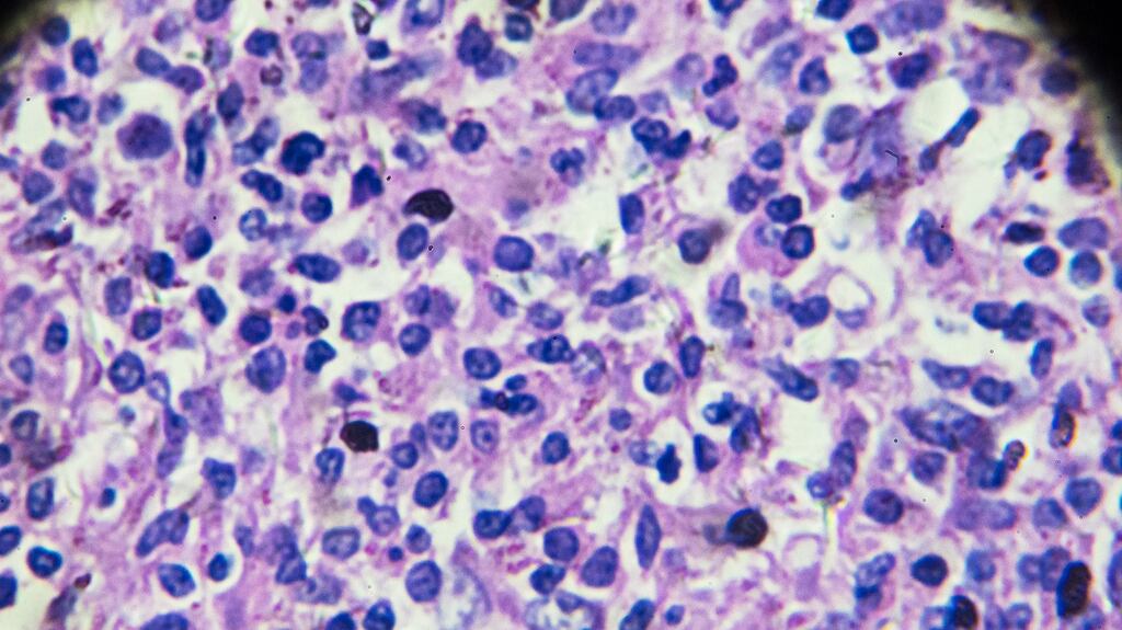 Drug delivery business Avectas has licensed a therapy from Galway-based ONK Therapeutics that targets what are called B-cell malignancies – blood cell cancers such as non-Hodgkin’s lymphoma (above)