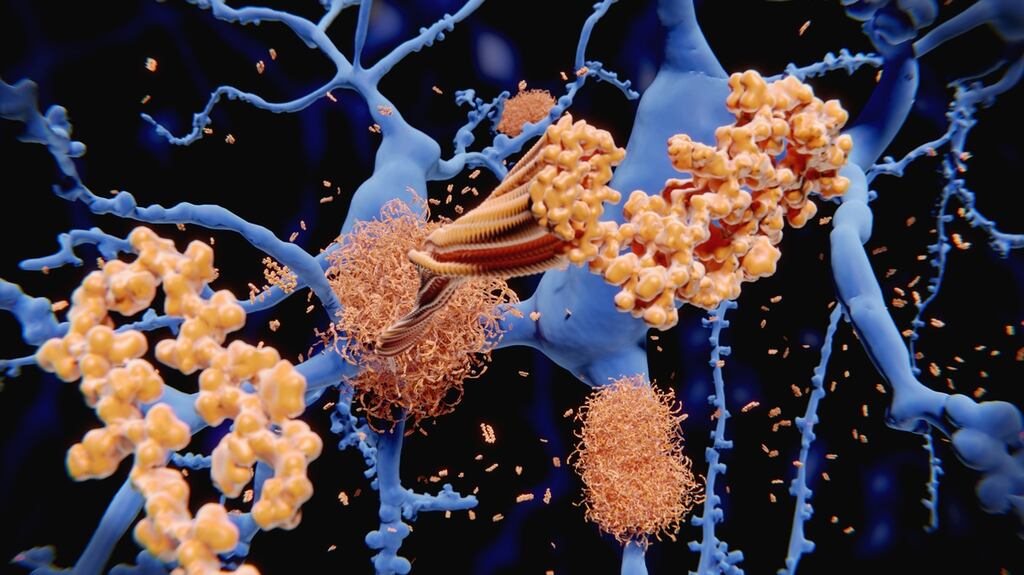 Biogen’s Alzheimer’s drug, which is given as an infusion, was approved by US regulators in June. Photograph: iStock