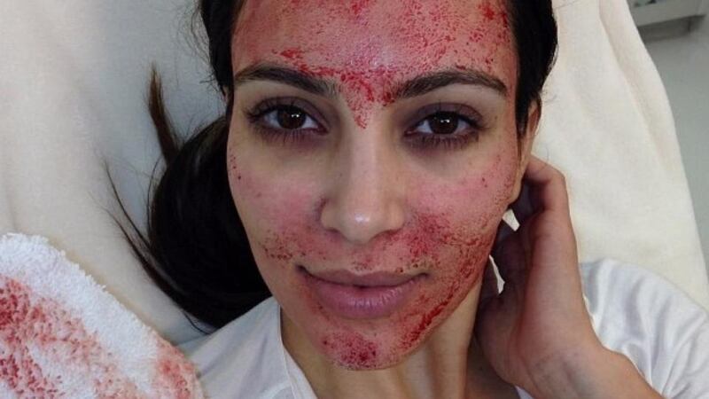 Kim Kardashian after her “vampire facial”