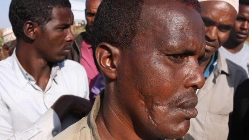 At a camp for displaced Somalis in Kolenchi, this man was allegedly shot in the face by Oromo police. On the other side of his face are other wounds from when the police shot him while he was lying on the ground afterwards. Photograph: James Jeffrey
