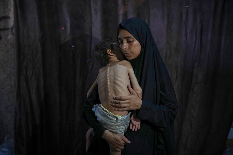 The Gaza health ministry has said 93 children have died of causes related to malnutrition since the war in Gaza started in 2023. Photograph: Jehad Alshrafi/AP