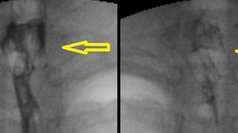 An X-ray of the swallowed pill packet. Photograph: BMJ Journals/PA