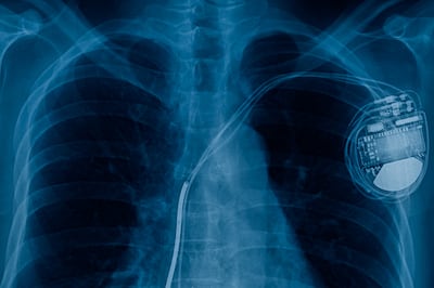 RF can interact with some electronic medical devices, such as implanted defibrillators, by causing electromagnetic interference (EMI). Photograph: iStock