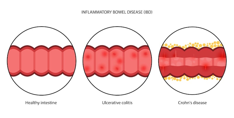 Stress and common medications, such as certain painkillers and antibiotics, may be triggers for IBD flare-ups
