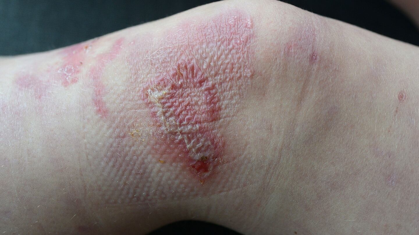 Erica Hyland’s knee, showing the blistering caused by epidermolysis bullosa (EB). Photograph: Dave Meehan/The Irish Times