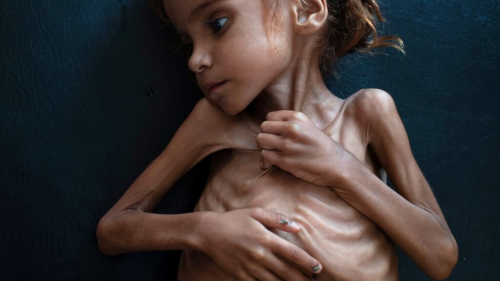 Amal Hussain (7), suffering from severe acute malnutrition, lying  in a bed at a mobile clinic run by Unicef in Aslam, Yemen, on October  18th. She died on October 26th, three days after being discharged from hospital. Photograph: Tyler Hicks/The New York Times