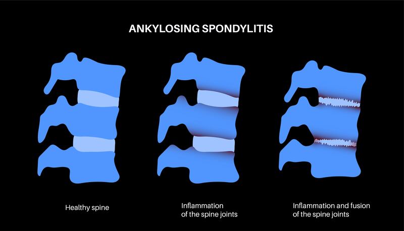 Ankylosing spondylitis, also known as axial spondyloarthritis, effects on the spine