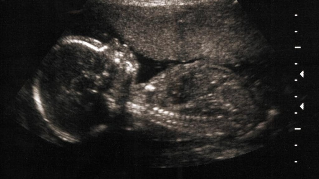An ultrasound image of a five-month-old foetus. The majority of the Joint Oireachtas Committee on the Eighth Amendment proposed to allow abortion in the first 12 weeks of pregnancy “with no restriction as to reason”.