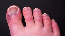 ‘Covid toes’ may be side effect of immune system response, study finds