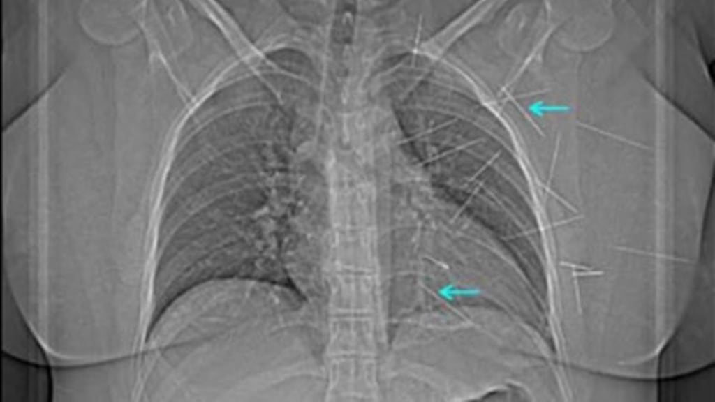 An X-ray showing some of the sewing needles lodged in a woman’s chest.